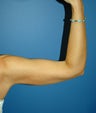 liposuction arms