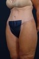 65 Year Old Female - Lower Body Lift