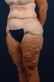 65 Year Old Female - Lower Body Lift