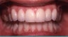 Smile Makeovers