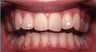 Smile Makeovers