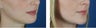 Before & After Chin Implant