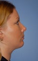 Facial Liposuction