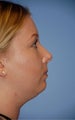 Facial Liposuction