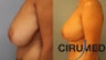Mastopexy