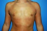 gynecomastia