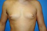 gynecomastia