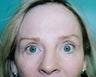 Female patient who underwent botox treatment