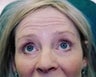 Female patient who underwent botox treatment