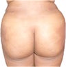 Butt Lift – Fat Grafting