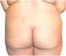 Butt Lift – Fat Grafting