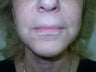 Mini Lift can be used to correct a previous face lift that did not have good results
