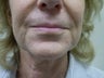 Mini Lift can be used to correct a previous face lift that did not have good results