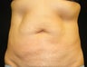 CoolSculpting