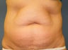 CoolSculpting