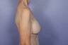 57 yr old Breast Augmentation and Lift