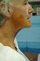 neck lift in a bariatric patient