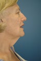 neck lift in a bariatric patient