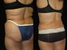 63 year old woman SmartLipo Waist and Flanks