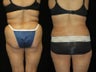 63 year old woman SmartLipo Waist and Flanks