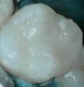 Removal and Replacement of Silver Amalgam Fillings