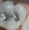 Removal and Replacement of Silver Amalgam Fillings