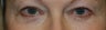 Blepharoplasty - Eyelid Lift
