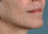 Facial Correction with filler