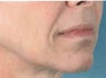 Facial Correction with filler