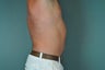 Liposuction