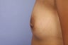 Inverted Nipple Repair