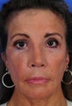Revision Rhinoplasty