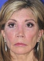 Revision Rhinoplasty