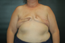 Breast Reconstruction