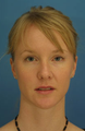 Nasal Fracture Repair