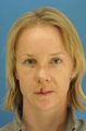 Nasal Fracture Repair