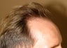 ARTAS robotic hair transplantation