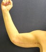 Arm Lift After Weightloss