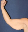 Arm Lift After Weightloss