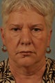 Eyelid Surgery