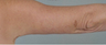 Arm Lift