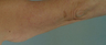 Arm Lift