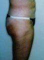 Female patient who underwent a thigh lift
