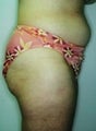 Female patient who underwent a thigh lift