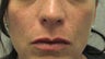 Restlane to the Lips