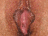 Labiaplasty