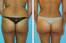 Liposuction Before & After