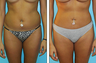 Liposuction Before & After