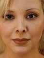 Hispanic Female Revision Rhinoplasty