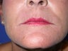 peri oral dermabrasion for smoker's lines
